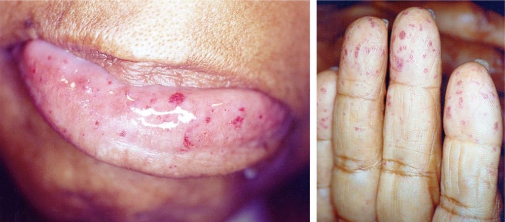 Osler Weber Rendu Disease OWR