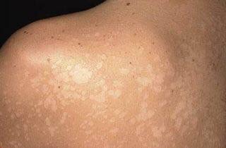 เกลื้อน Pityriasis versicolor