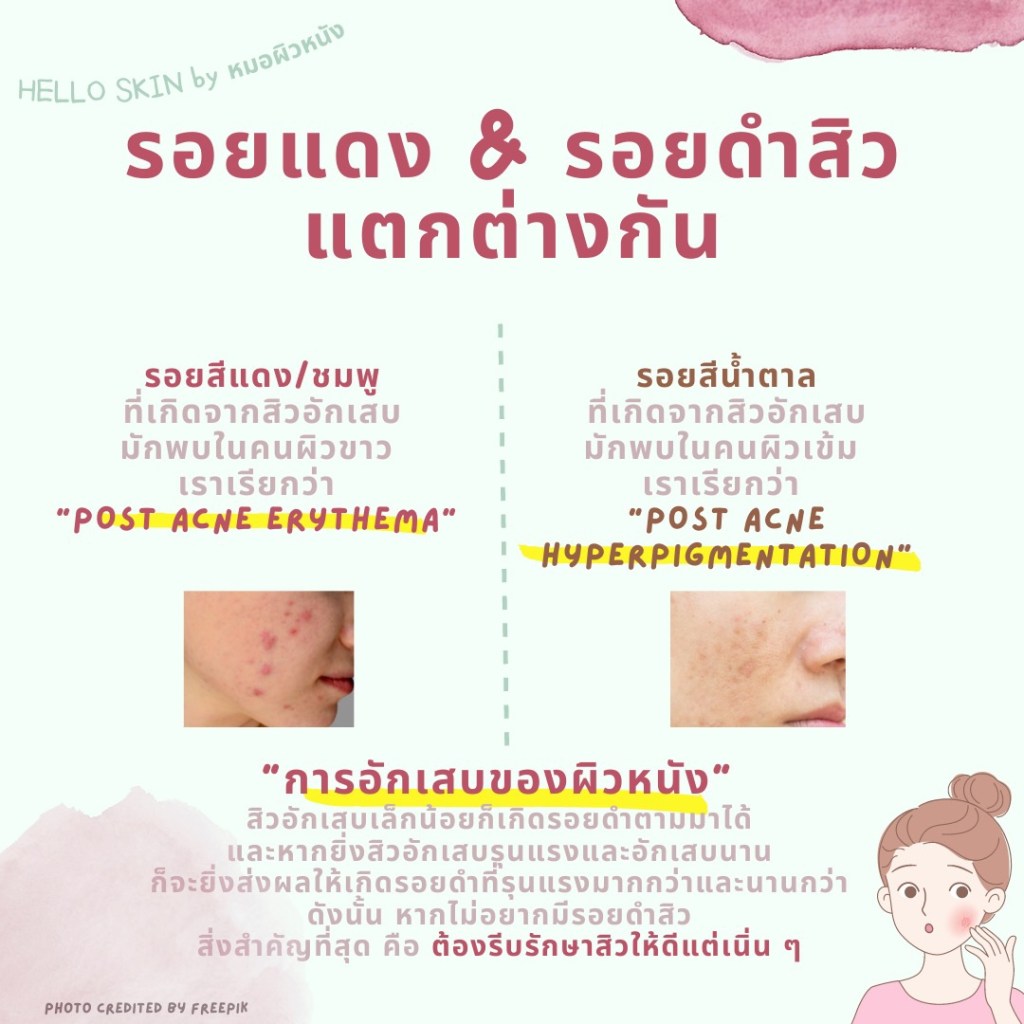 รอยแดงสิว รอยดำสิว แตกต่างกัน