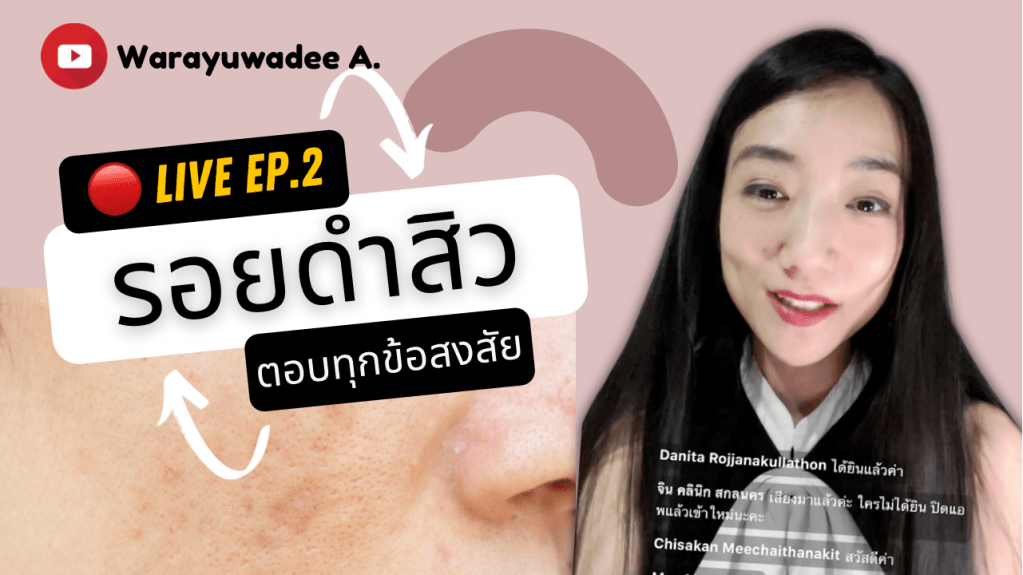 รอยดำสิว 