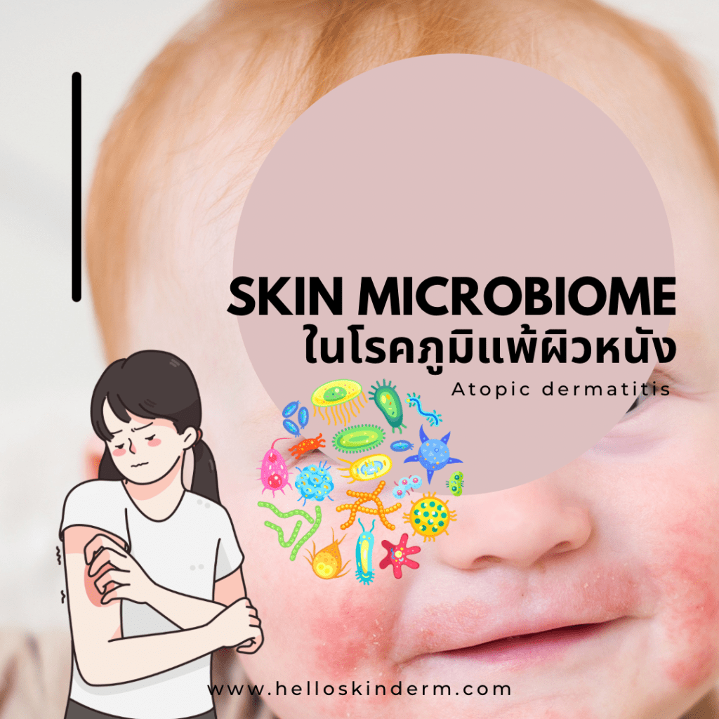 Skin microbiome in atopic dermatitis helloskinderm 